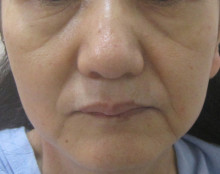 顔全体のたるみ治療前の写真