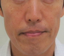 グロースファクターによる顔全体のたるみ治療後