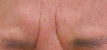 グロースファクターによる眉間のしわ治療前の写真