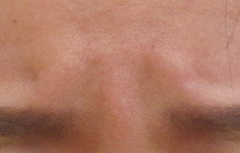 グロースファクターによる眉間のしわ治療後の写真