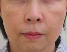 顔全体のたるみ治療後の写真