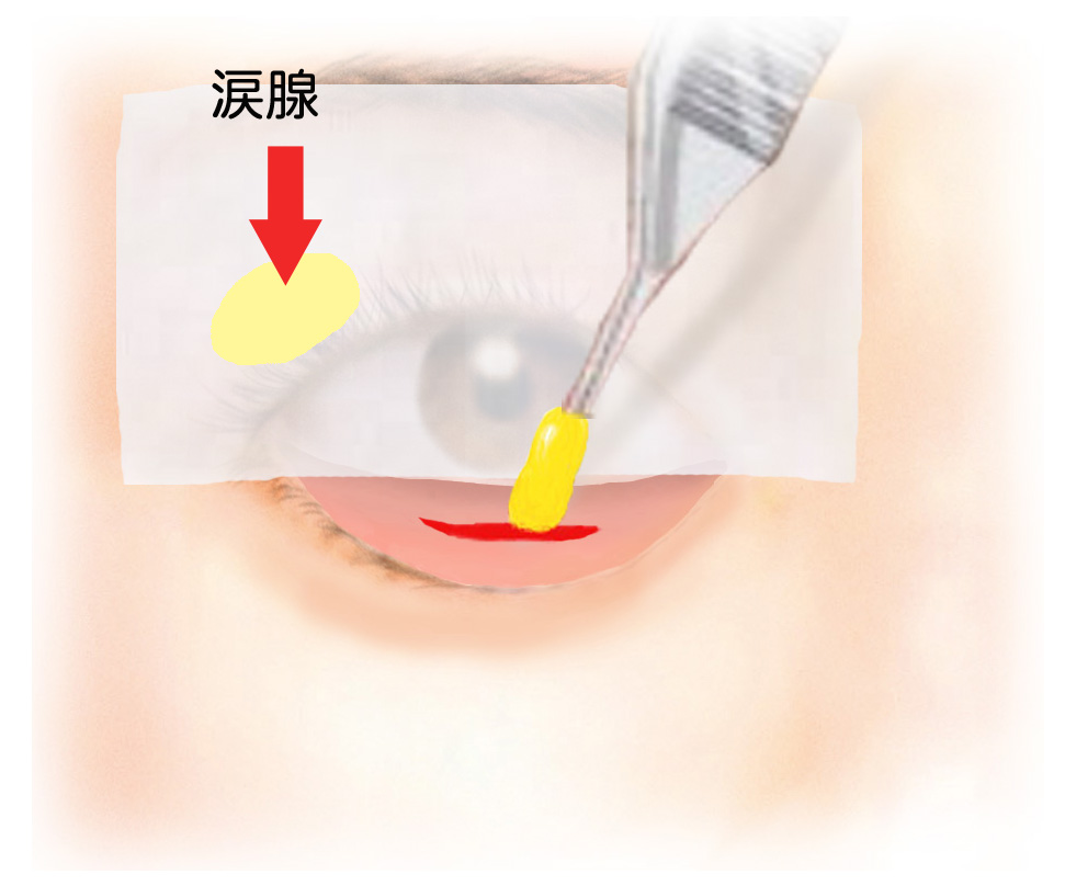 経結膜脱脂法60－涙腺の場所