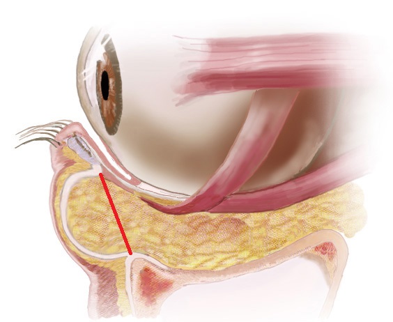 経結膜脱脂法３０－目の下の治療ー術前脂肪の本来の位置2