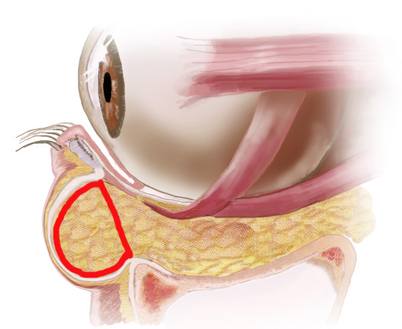 経結膜脱脂法３１術前眼窩イラスト　切除部位